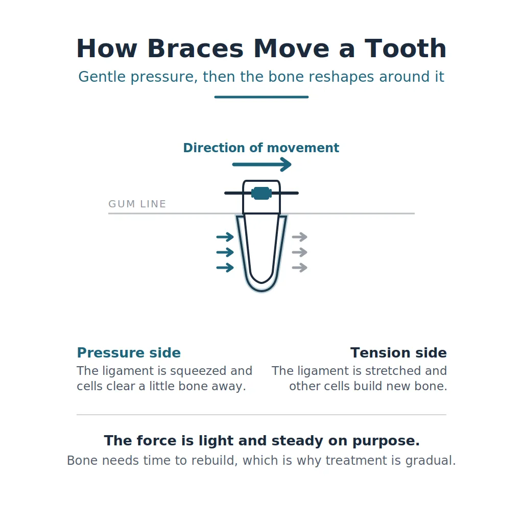 Cross-section diagram of a tooth in its socket showing braces pressure, with bone breaking down on the pressure side and new bone forming on the tension side.